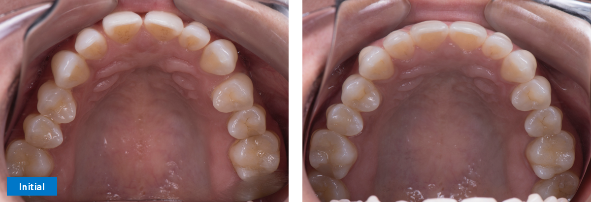 Upper Occlusal