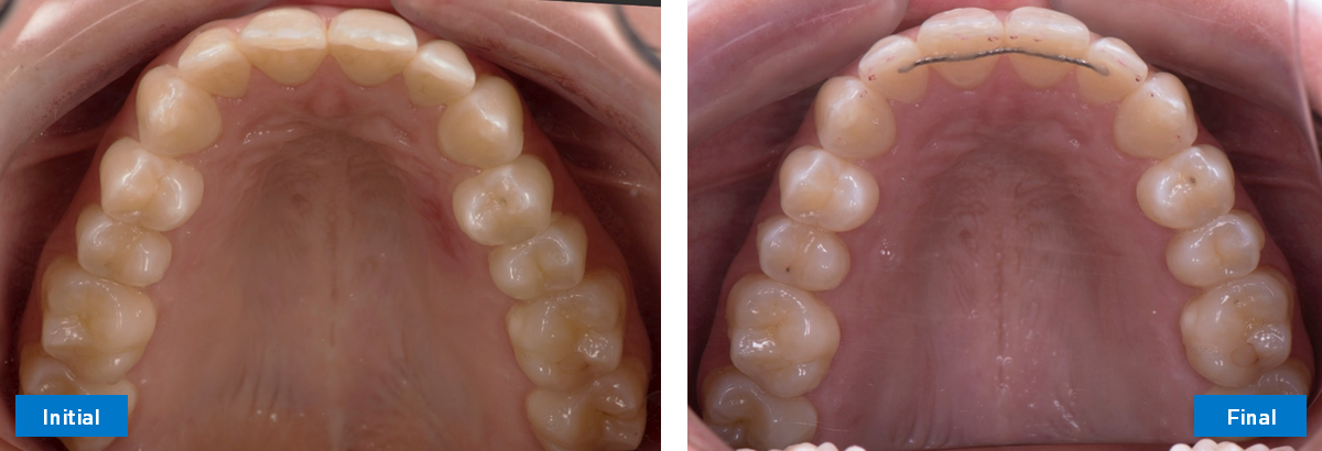 Upper Occlusal