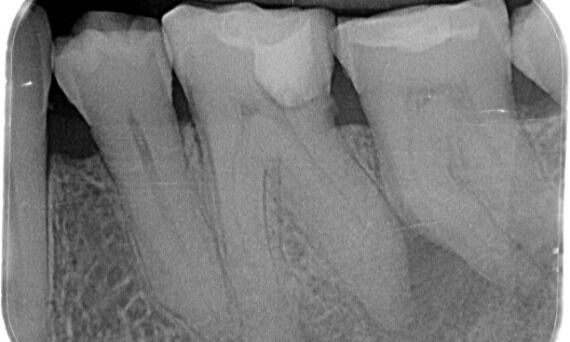 Image of Preoperative radiograph 