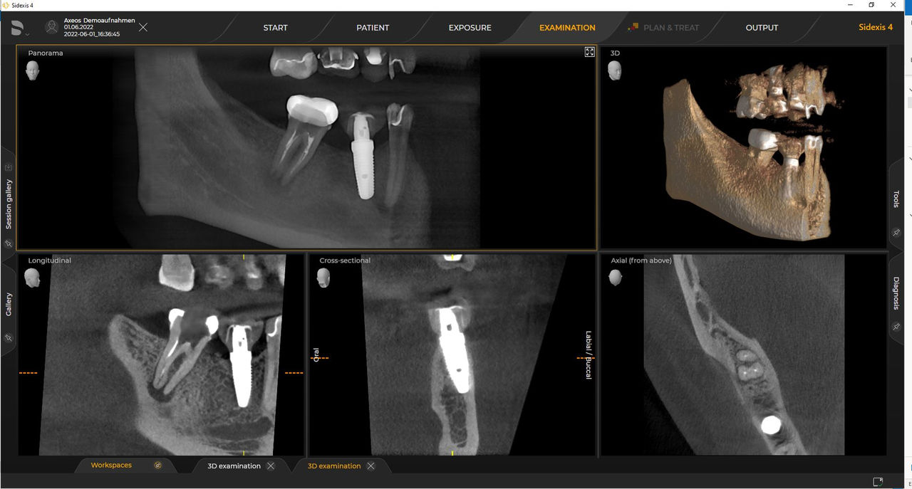 Radiología 3D Ø 5 cm x 5,5 cm HD