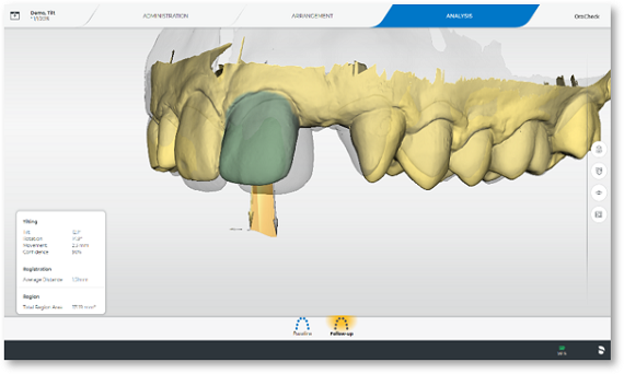 Tooth movements, OraCheck 5