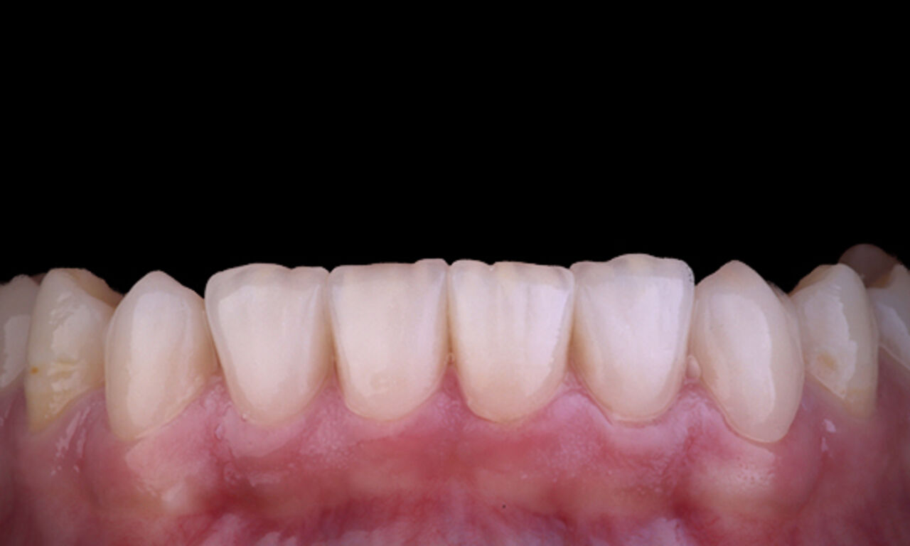 CEREC Tessera with Celtra Ceram Case Study Image - After 