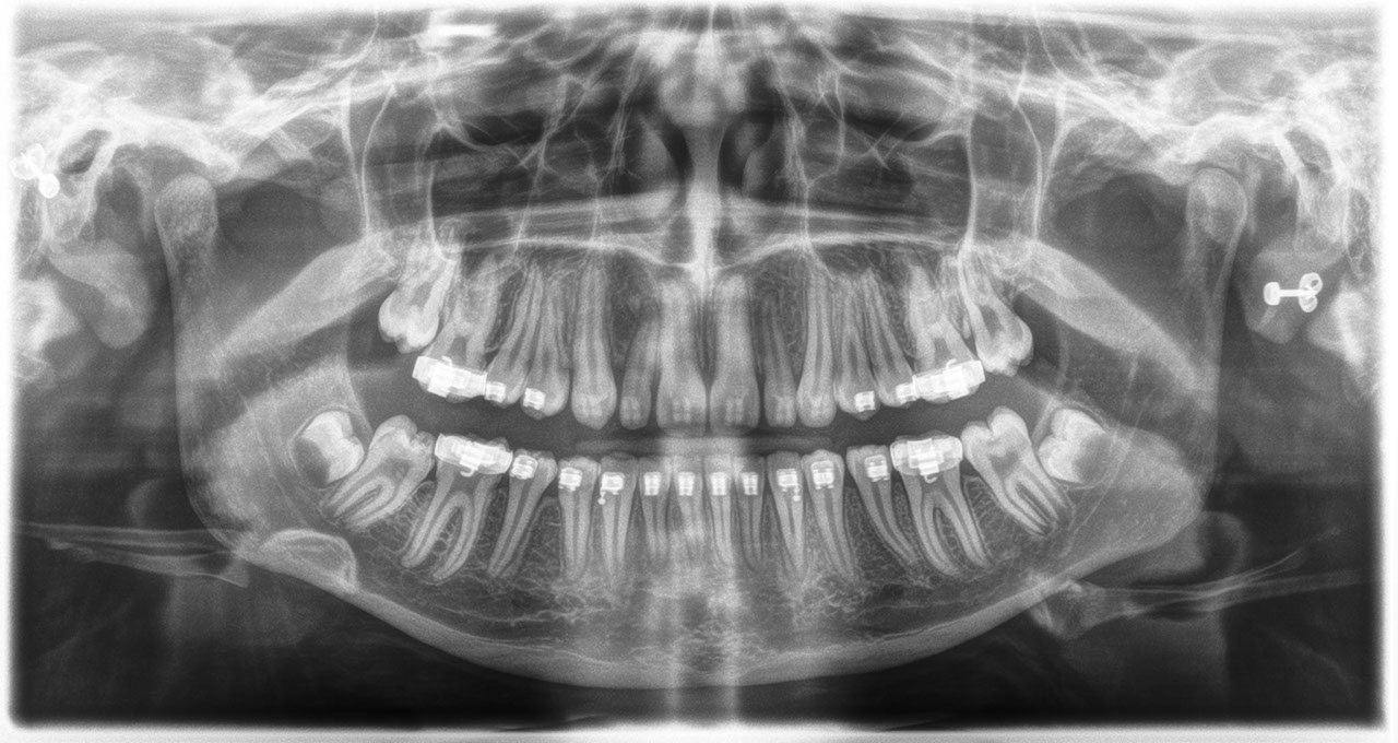 Radiografía extraoral 