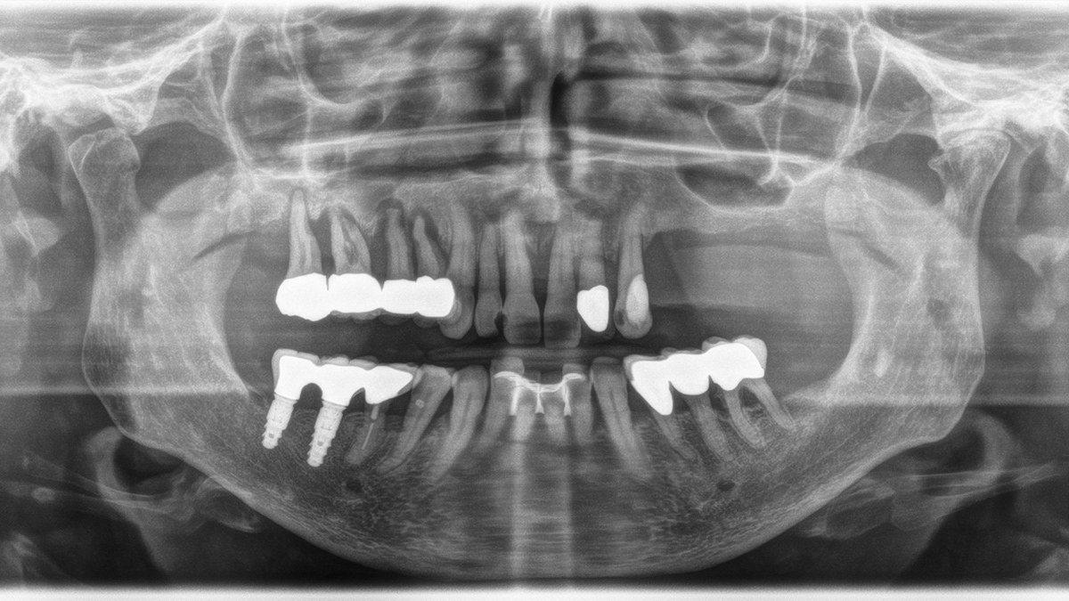 Radiografía que muestra implantes