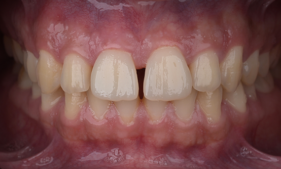 After Image | CEREC Tessera Case Study |  Dr. Mohamed Hassanien