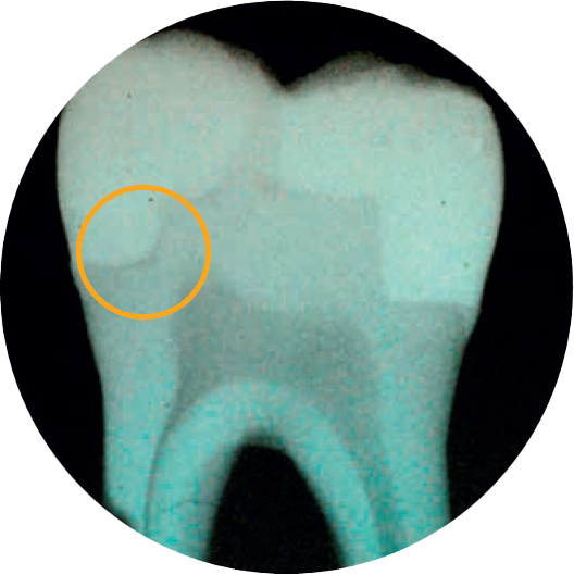 Class II | Prime&Bond Adhesive Placement | without Text