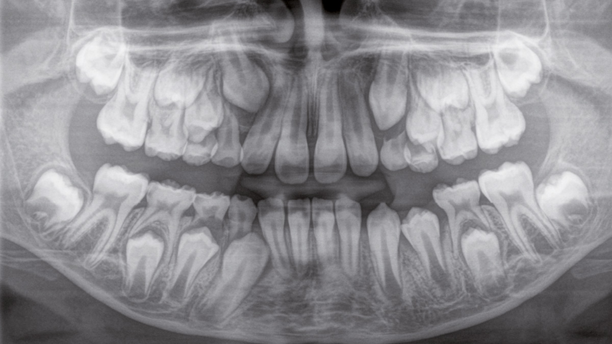Imagen radiológica dental de un paciente infantil