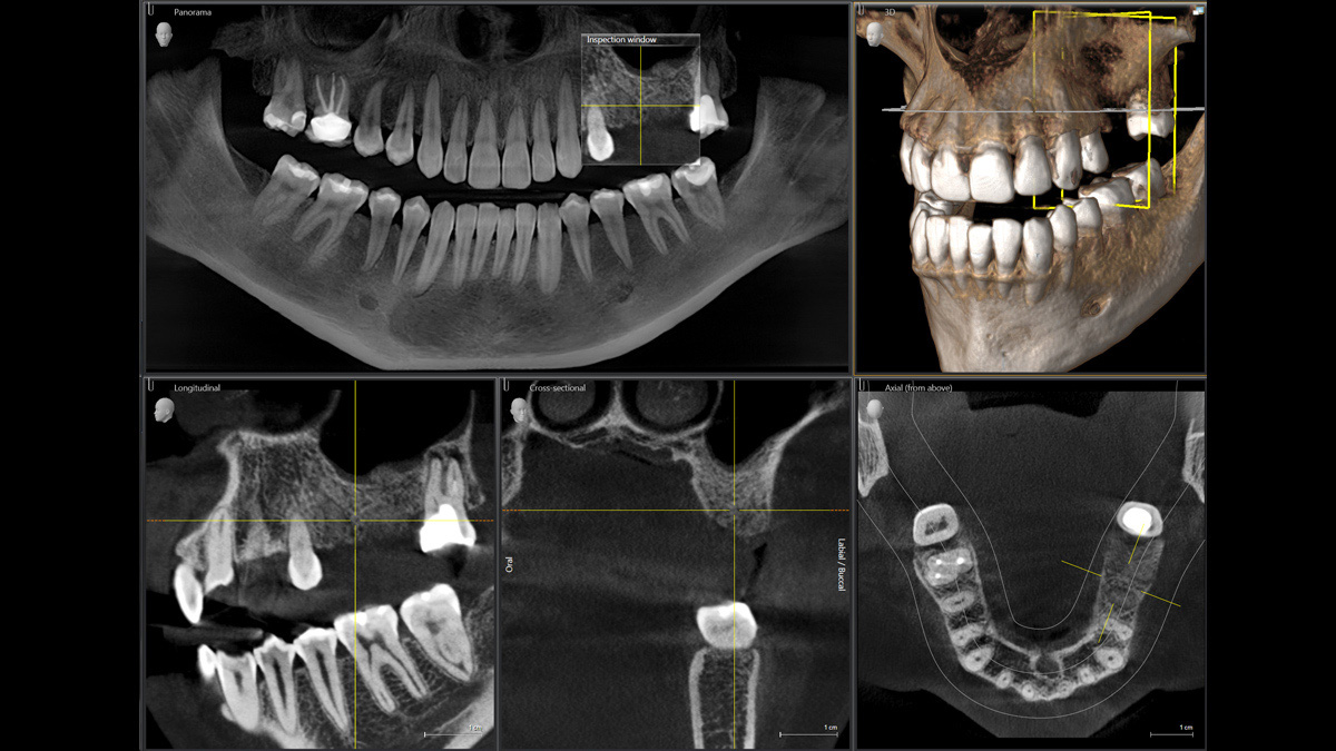 Radiografía dental de un caso de implante