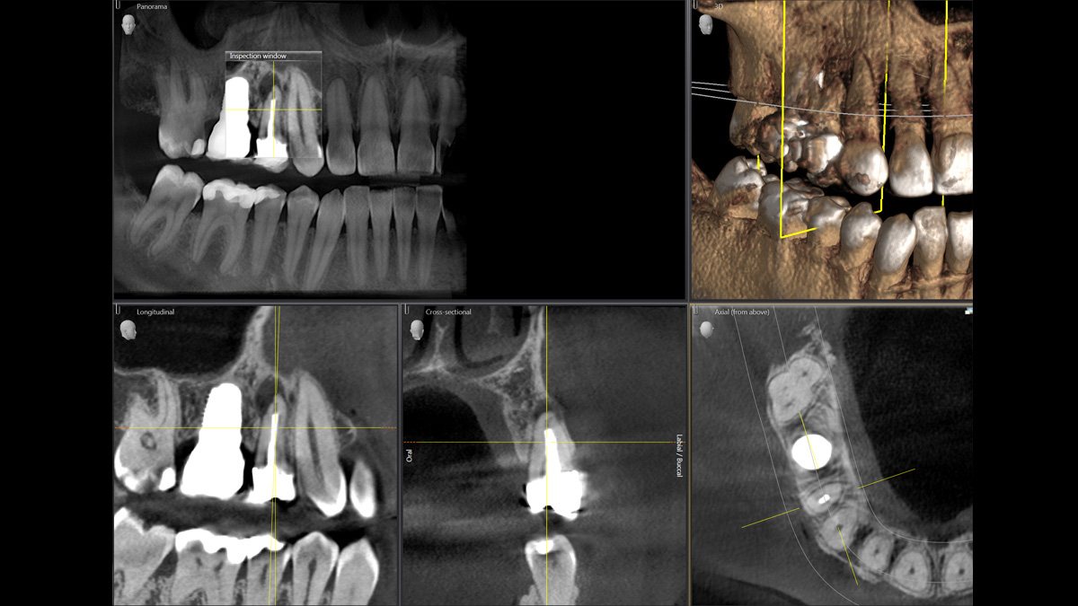 Caso de radiografía dental de 5 cm x 5,5 cm HD de 80 μm