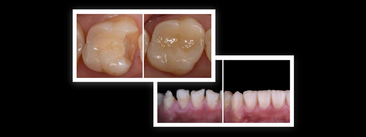 CEREC Tessera | Clinical Case Teaser