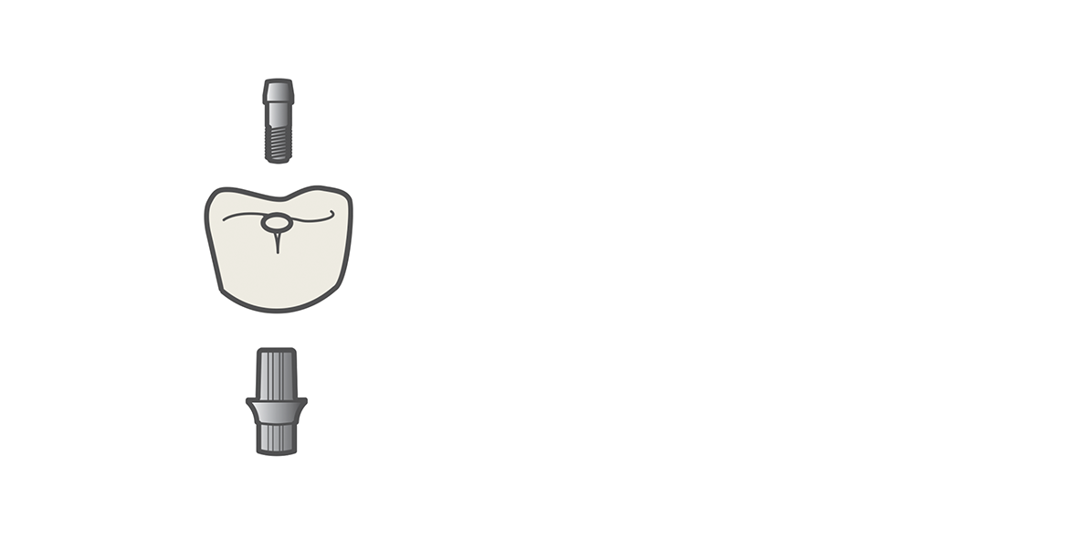 CEREC Tessera | Workflow | Cementation Abutment Crown