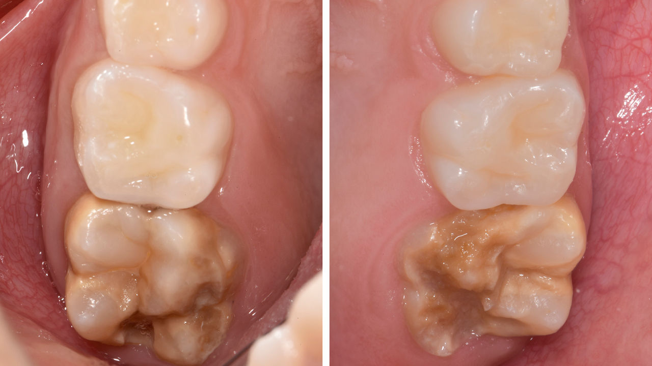 Dientes 16 y 26 afectados por hipomineralización grave. Puntaje 4c de MHI-TNI (Bekes y Steffen 2016)