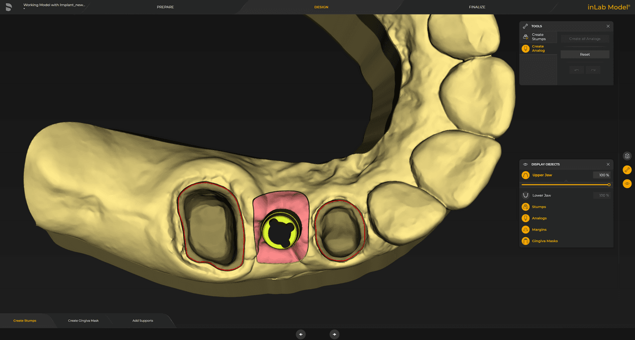 Para los modelos de implantes, el análogo del implante digital seleccionado se incluye automáticamente en el cálculo y se visualiza en el software.