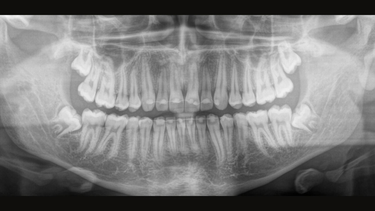 Radiografía extraoral