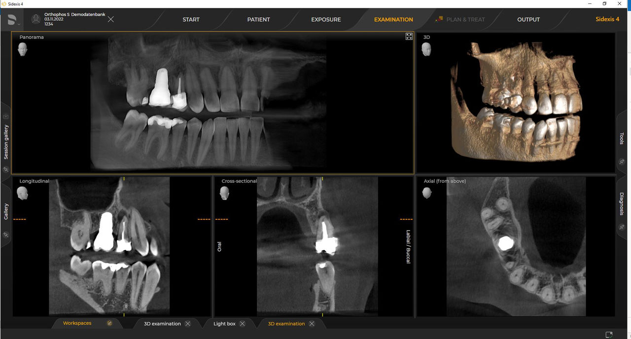 Imagen radiológica dental, caja de 5 cm x 5,5 cm HD de 80 μm