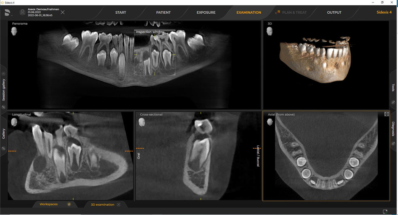 Radiología 3D Ø 8 cm x 5 cm Definición estándar