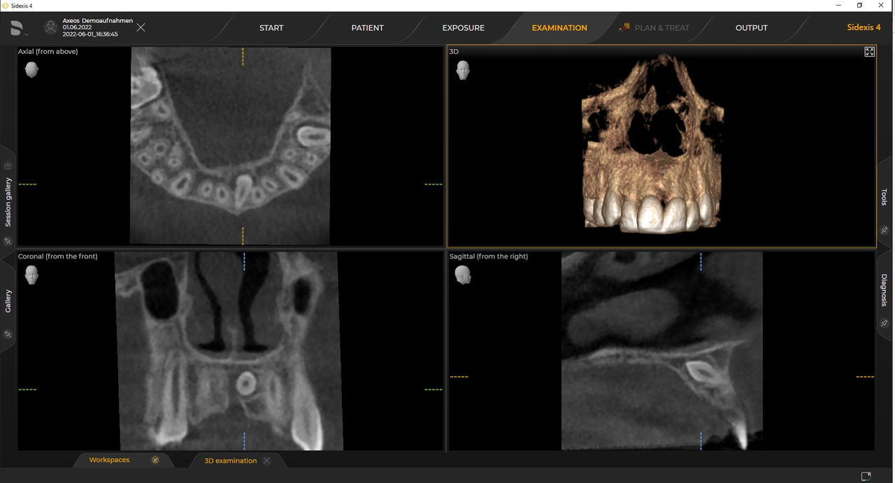 Radiología 3D Ø 5 cm x 5,5 cm Dosis baja