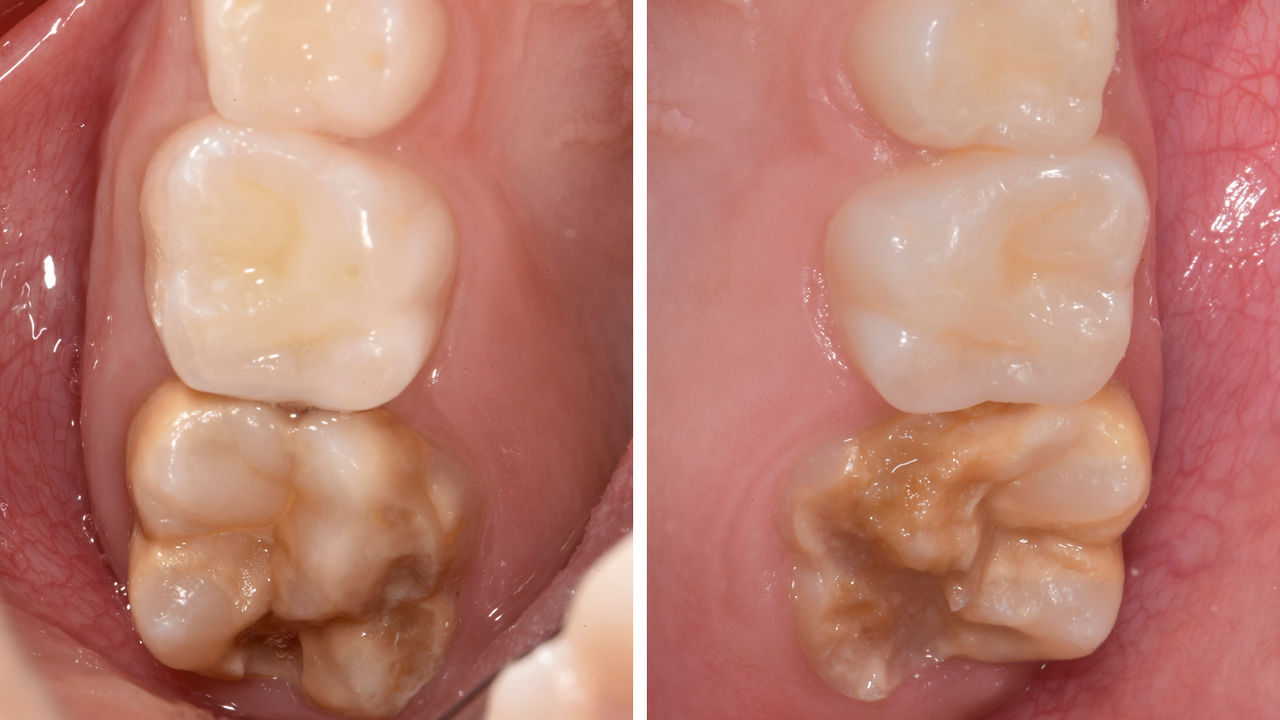 Les dents 16 et 26 sont touchées par une grave hypo-minéralisation. Score MHI-TNI 4c (Bekes et Steffen 2016)