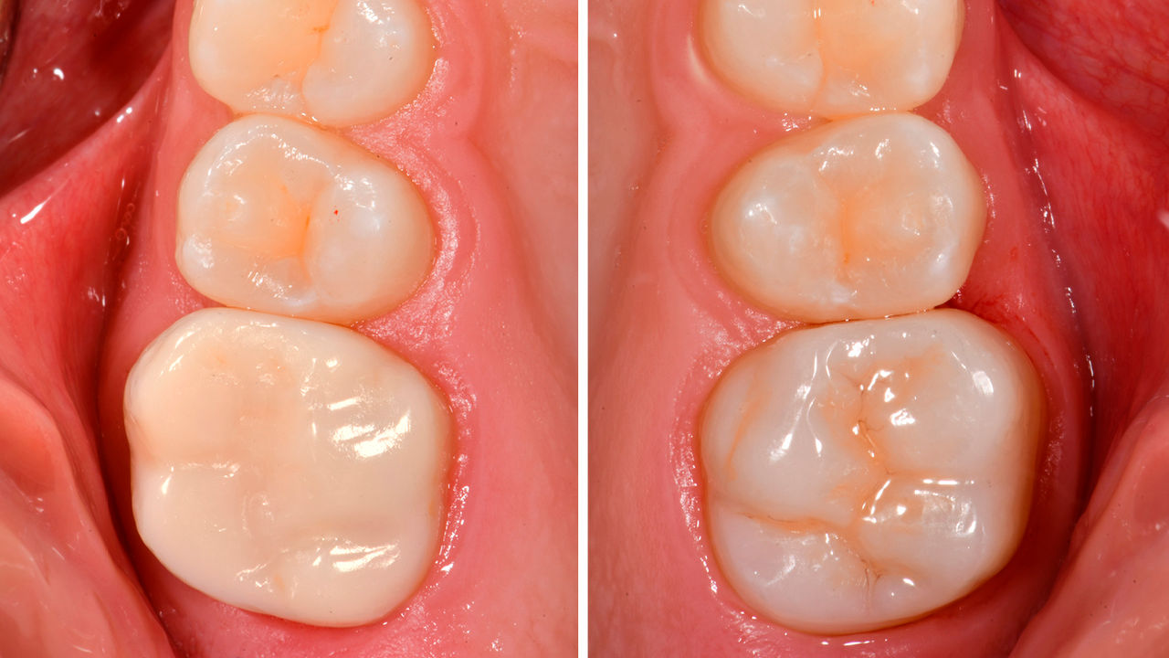Dents 16 et 26 après