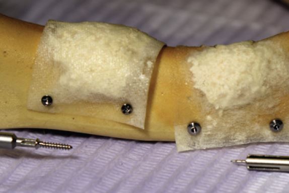 os de la mâchoire avec lambeau lingual