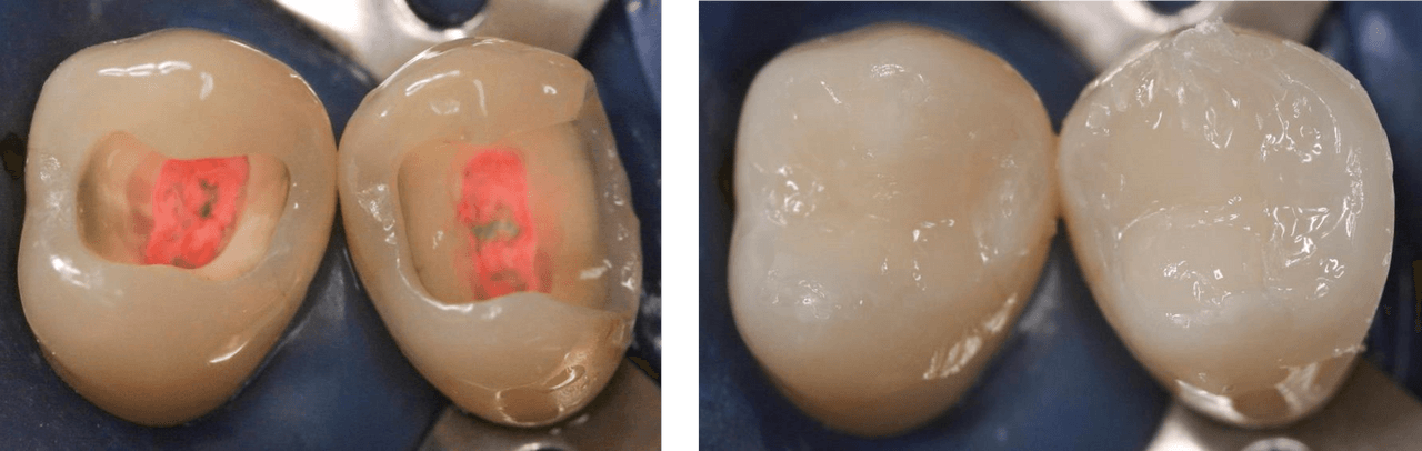 Figure 2 : Dents postérieures traitées endodontiquement avec quatre et trois parois coronaires et structure dentaire résiduelle légèrement abîmée avant et après restauration directe (avec l'aimable autorisation du Dr Marcus Holzmeier, Allemagne)