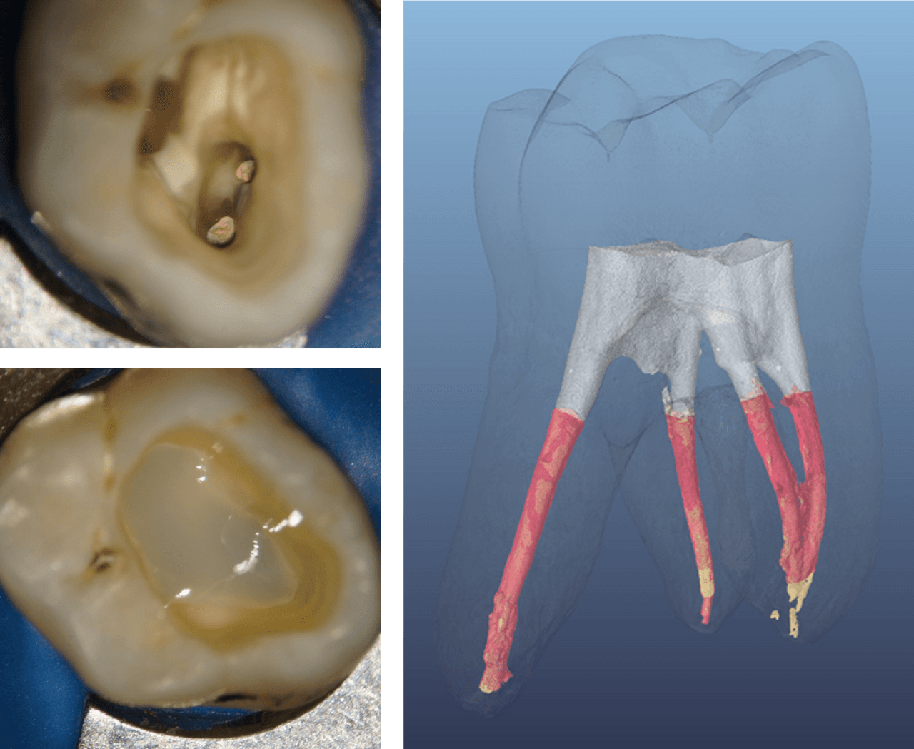 Figure 4 Analyse de la couche SDR flow+ initiale dans une cavité de classe I post-endodontique, à l'aide d'un micro-CT. La couche SDR flow+ (grise) montre un joint étanche aux parois de la cavité ainsi qu'une bonne adaptation au matériau d'obturation (rouge). (Source image : Paqué F., 2014 (réf. 14.1483))