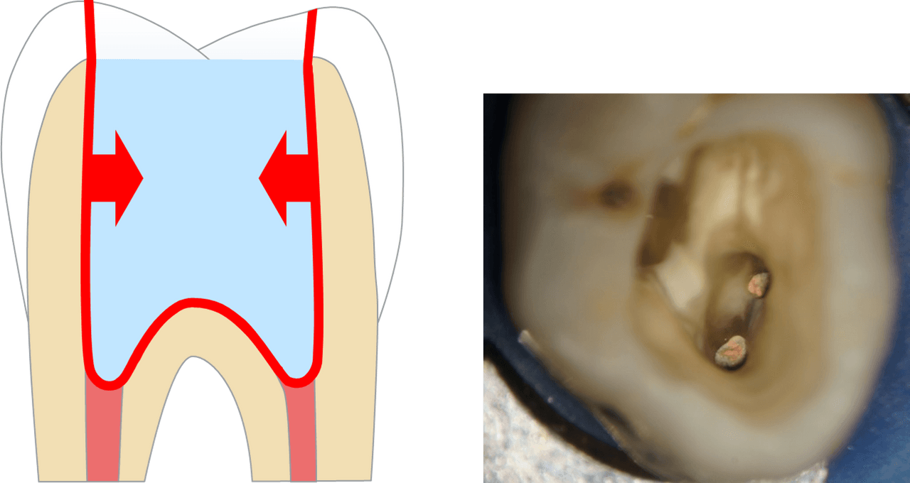 De grandes quantités de matériau d'obturation doivent être placées dans les cavités post-endodontiques postérieures, ce qui peut créer une contrainte de rétraction importante en raison de la quantité de surfaces collées