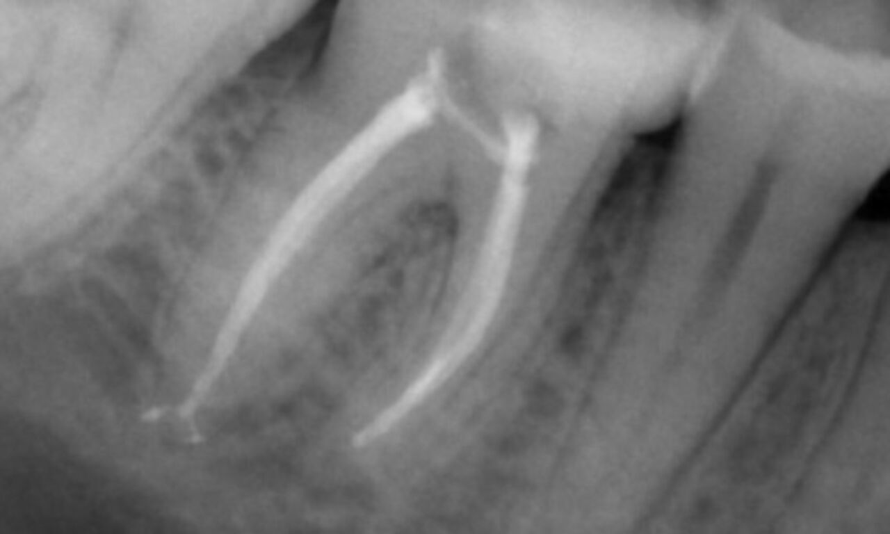 X線臨床症例 Abuelezz TruNatomy アフター