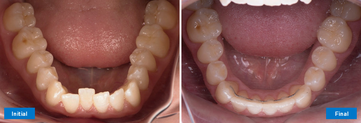 Occlusaal onder