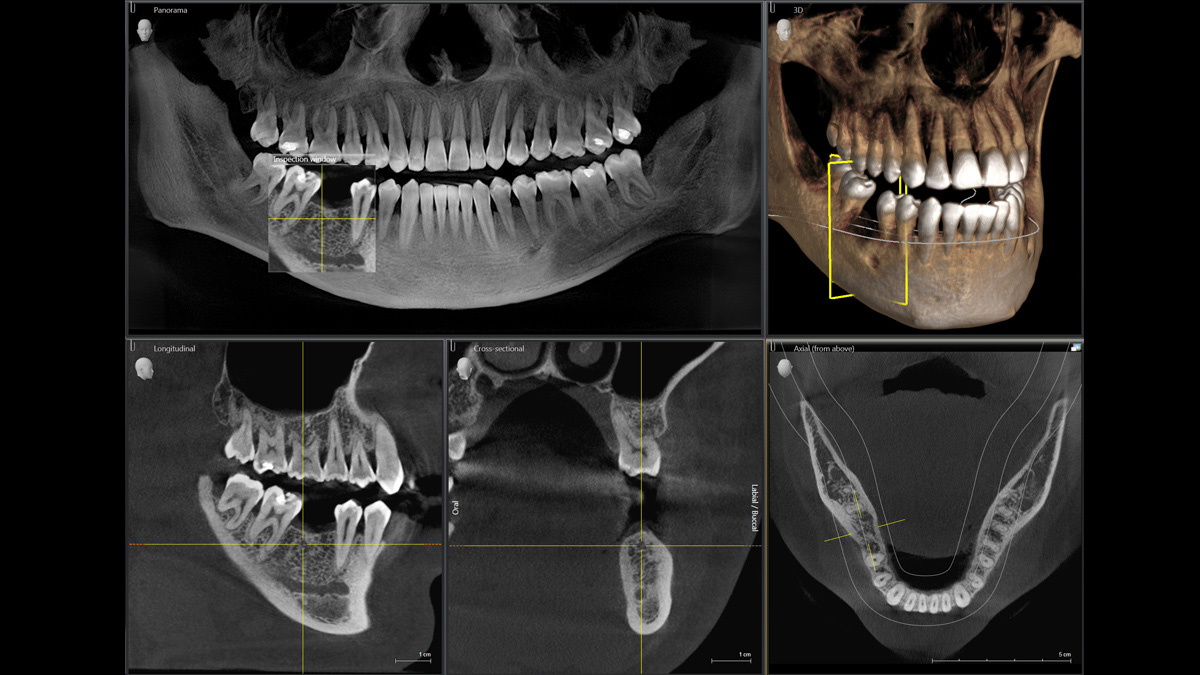 Tandheelkundige röntgenopname van een implantaatcasus