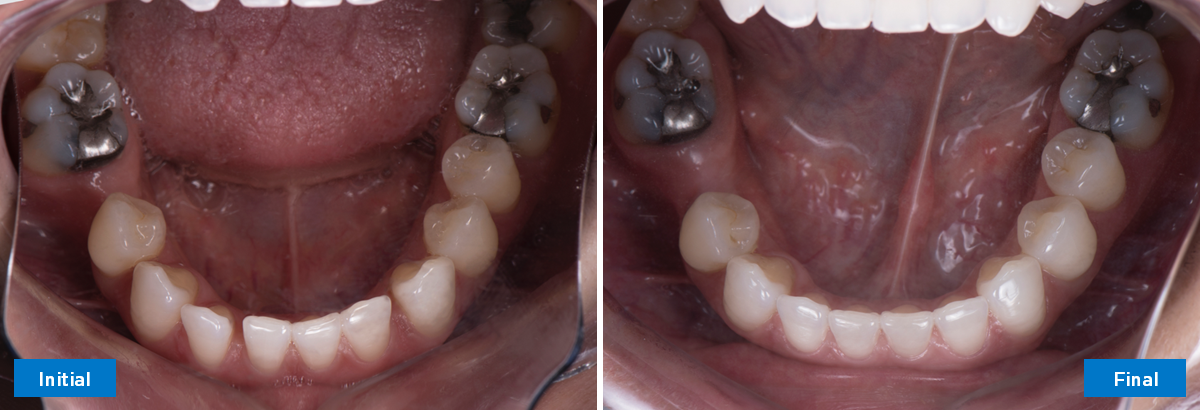 Occlusaal onder