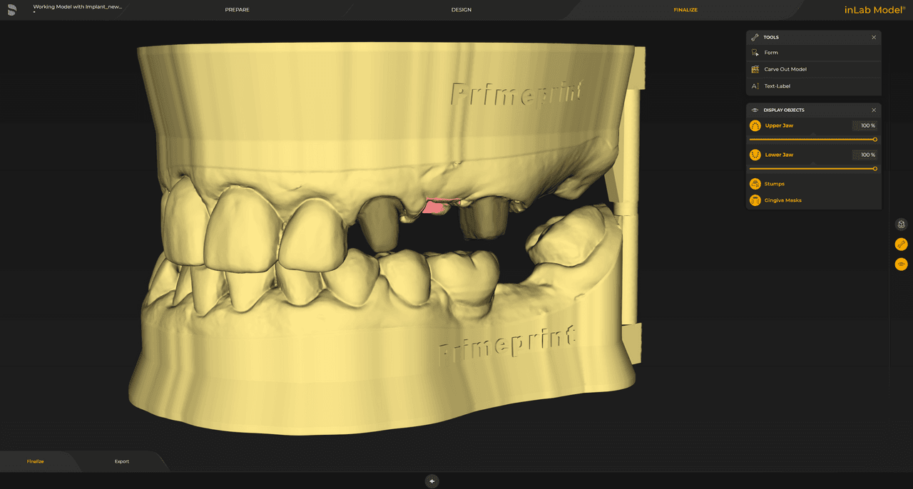 Os modelos de dados de moldagem digital podem ser projetados com matrizes removíveis ou não removíveis.