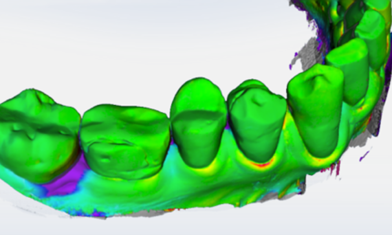 Gingival Recession Measurement, OraCheck 5