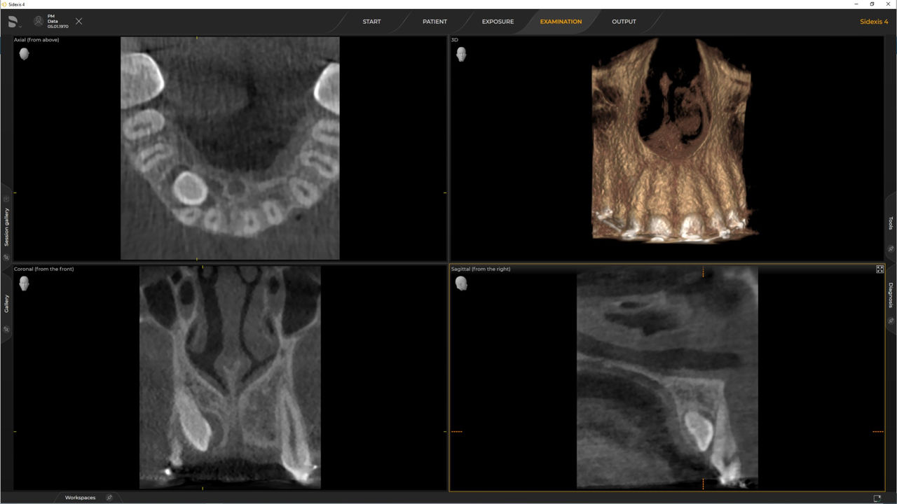 Radiografia dentária de um caso de implante