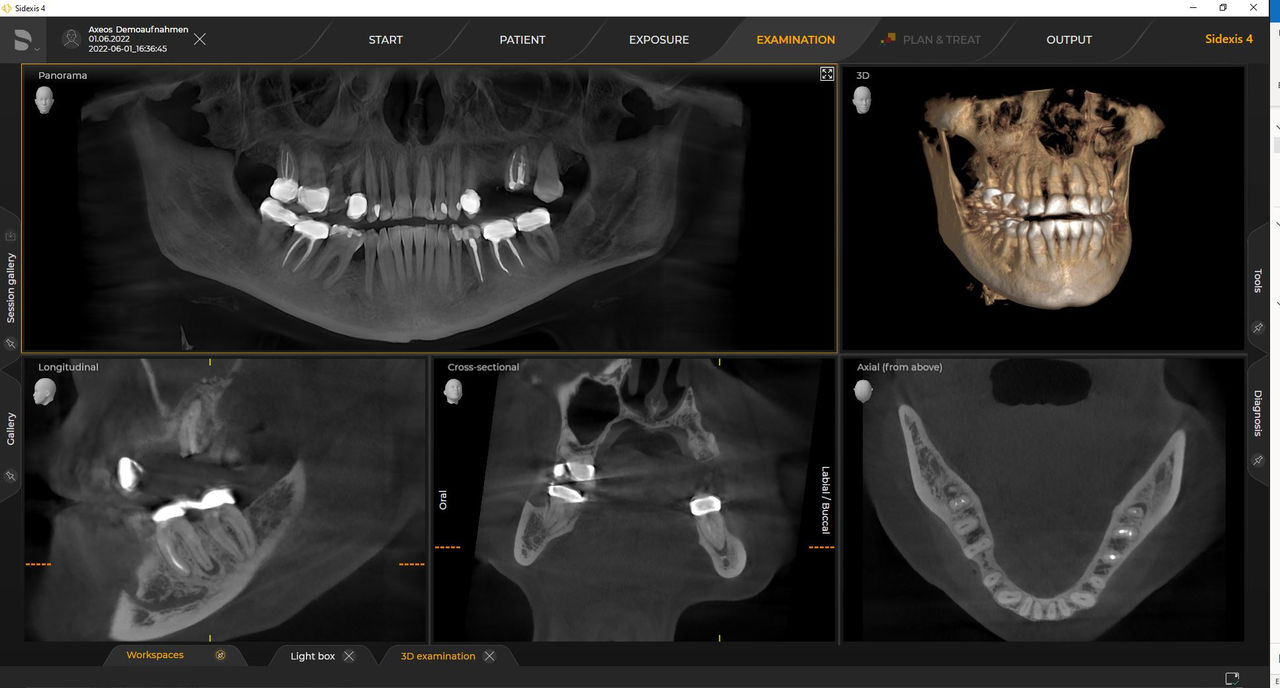 Raios X 3D Ø 11 cm x 10 cm HD