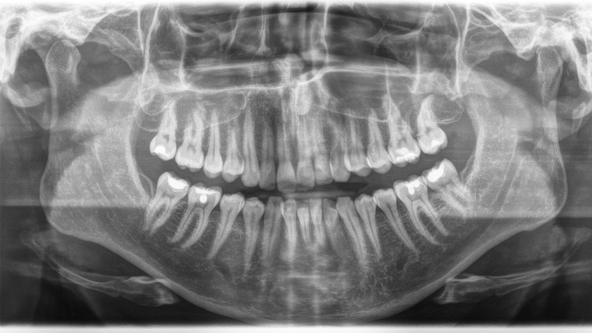 Radiografia mostra dentição completa tratada profilaticamente. 