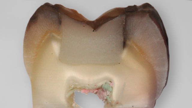 Зуб с микроподтеканием